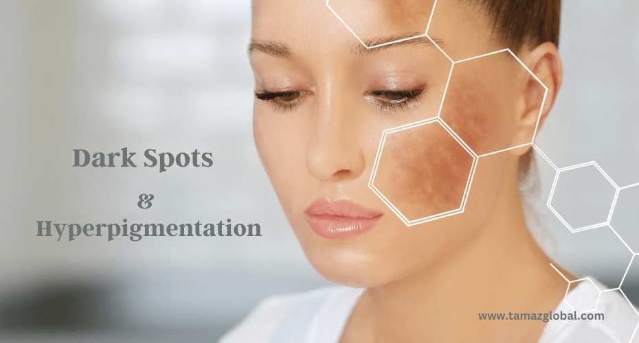 How to Treat Dark Spots and Hyperpigmentation